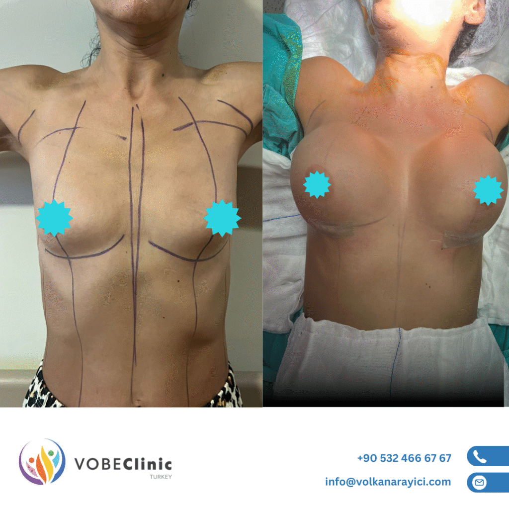 breast augmentation surgery in turkey