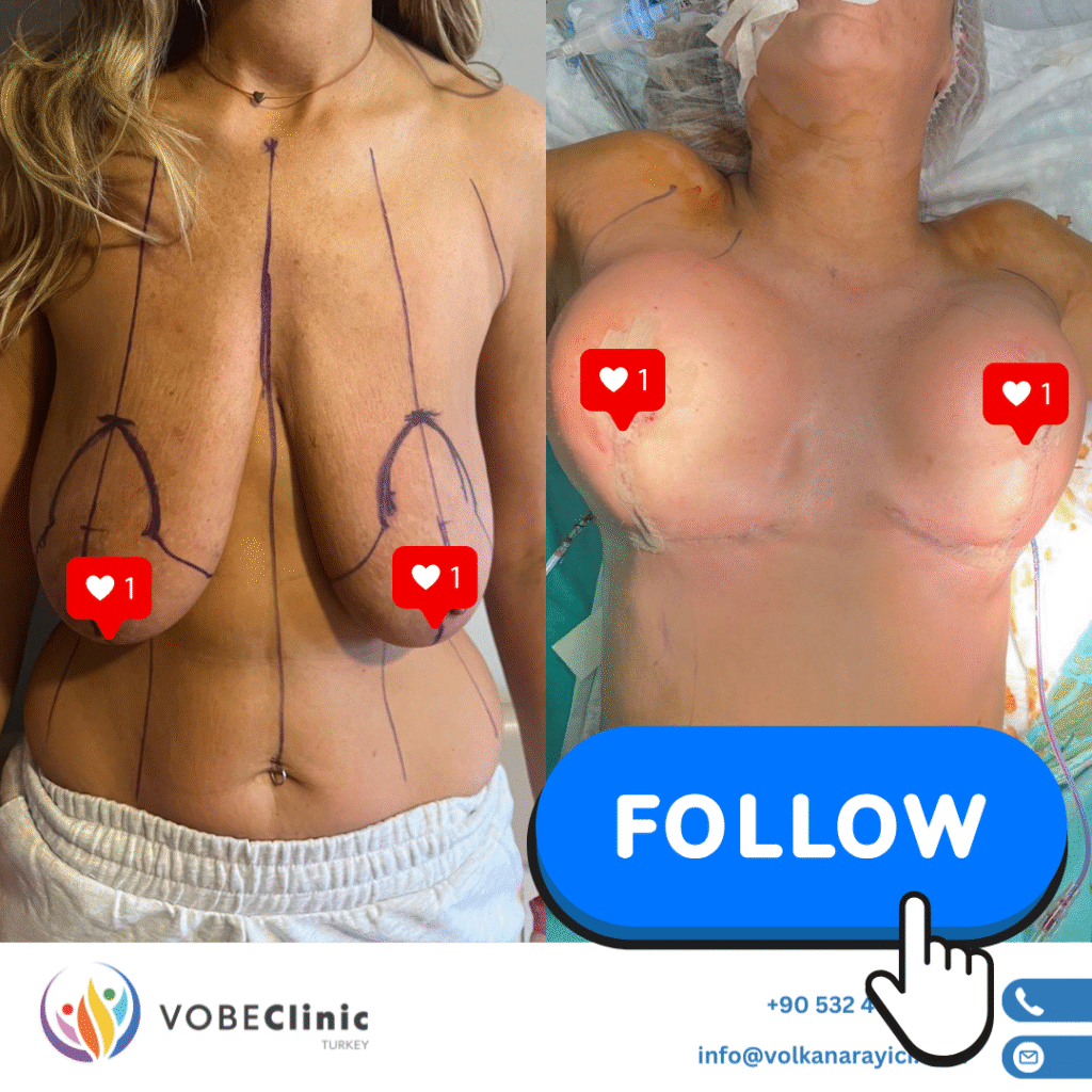 breast reduction surgery turkey cost