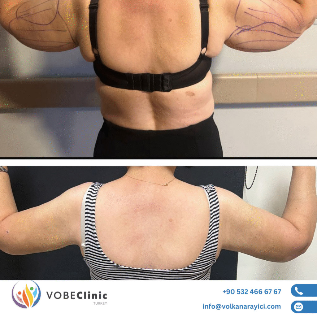 arm lift surgery turkey cost